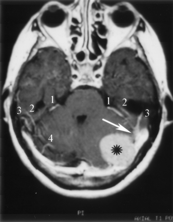 Fig 11.